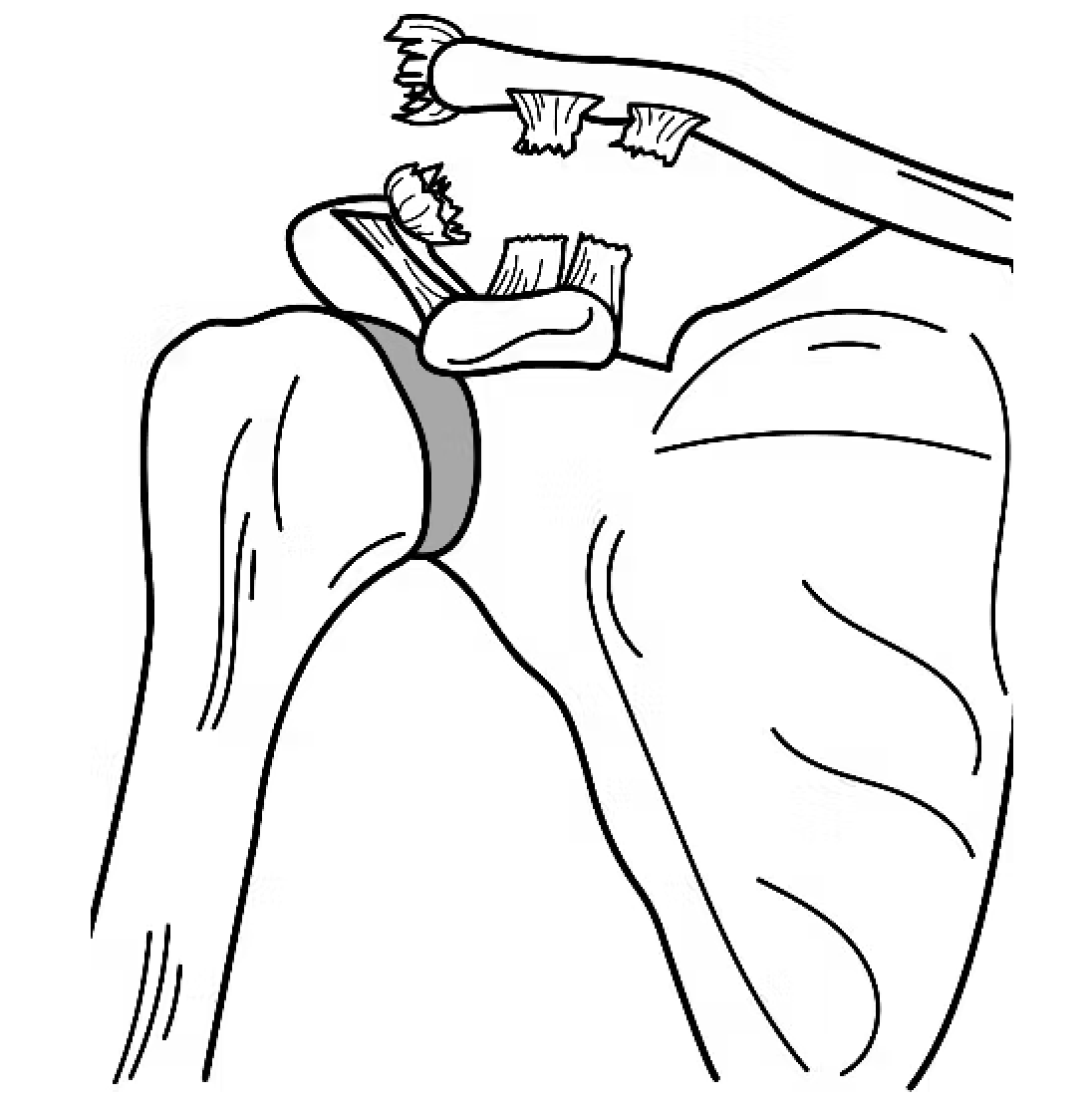 Disjonction acromio-claviculaire – Dr Geoffrey Ginot Rennes